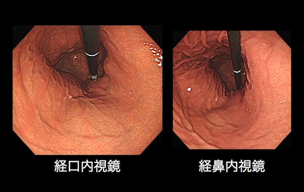 経口内視鏡と経鼻内視鏡の比較画像
